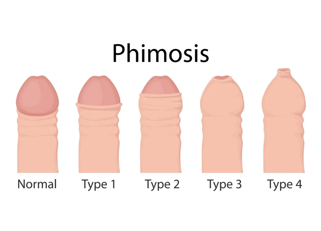phimosis