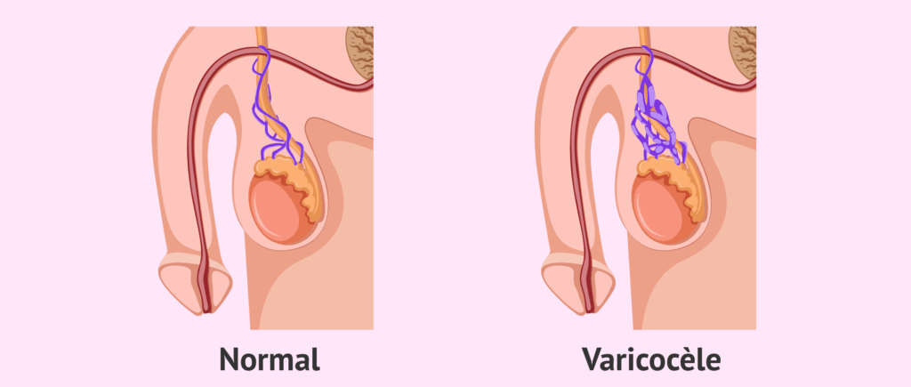 Varicocèle